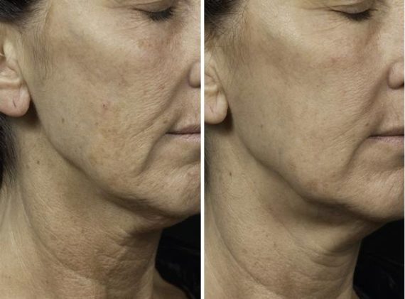 Fraxel Laser Before and After Photos in Houston, TX, Patient 7950