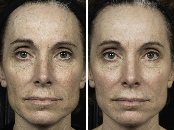 Fraxel Laser Before and After Photos in Houston, TX, Patient 7953