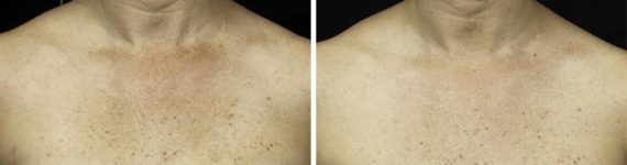 Fraxel Laser Before and After Photos in Houston, TX, Patient 7938