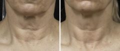 Fraxel Laser Before and After Photos in Houston, TX, Patient 7959