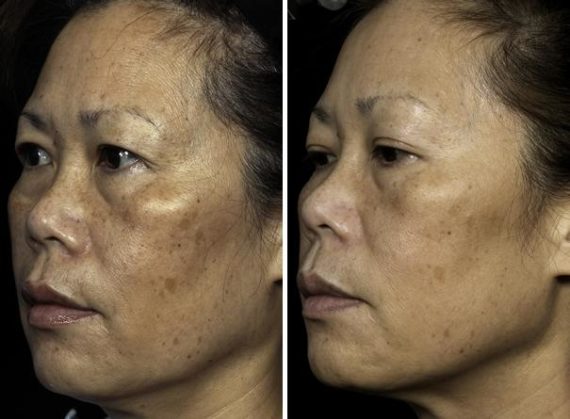 Fraxel Laser Before and After Photos in Houston, TX, Patient 7965