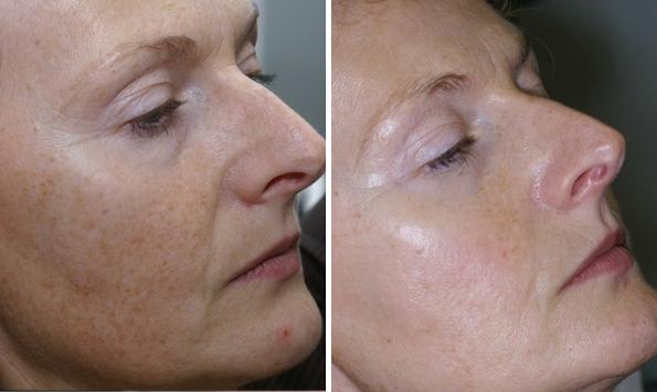 IPL Before and After Photos in Houston, TX, Patient 7983