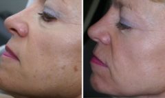 IPL Before and After Photos in Houston, TX, Patient 7980