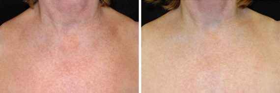 IPL Before and After Photos in Houston, TX, Patient 7989