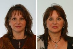 Juvederm Injectable Gel Before and After Photos in Houston, TX, Patient 7998