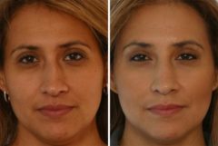 Juvederm Injectable Gel Before and After Photos in Houston, TX, Patient 8001