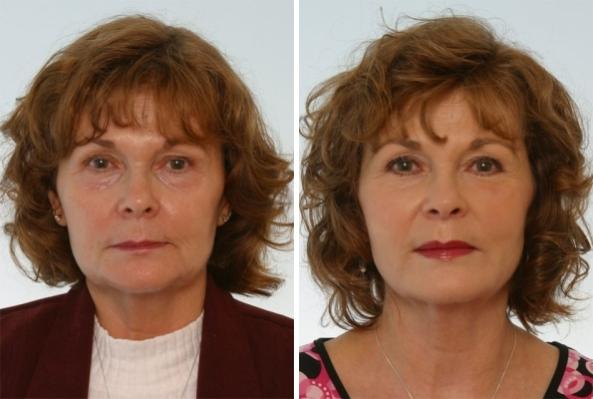 Juvederm Injectable Gel - Patient 1 - Before & After