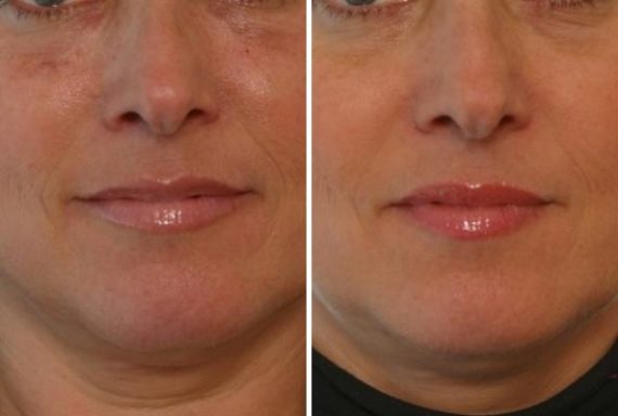Juvederm Injectable Gel Before and After Photos in Houston, TX, Patient 7995