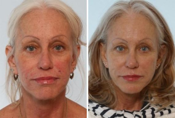 Juvederm Injectable Gel Before and After Photos in Houston, TX, Patient 8011