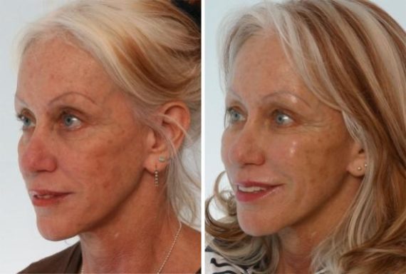 Juvederm Injectable Gel Before and After Photos in Houston, TX, Patient 8011