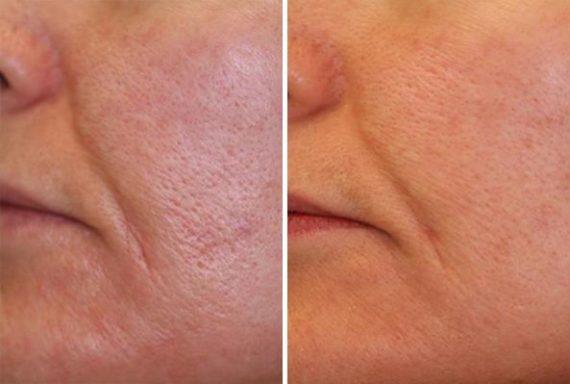 Laser Genesis Before and After Photos in Houston, TX, Patient 8019