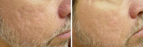 Laser Genesis Before and After Photos in Houston, TX, Patient 8025