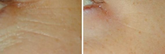 Laser Genesis Before and After Photos in Houston, TX