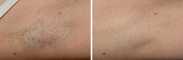 Laser Hair Removal - Patient 1 - Before & After