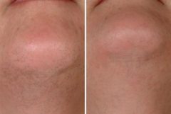 Laser Hair Removal Before and After Photos in Houston, TX, Patient 8045