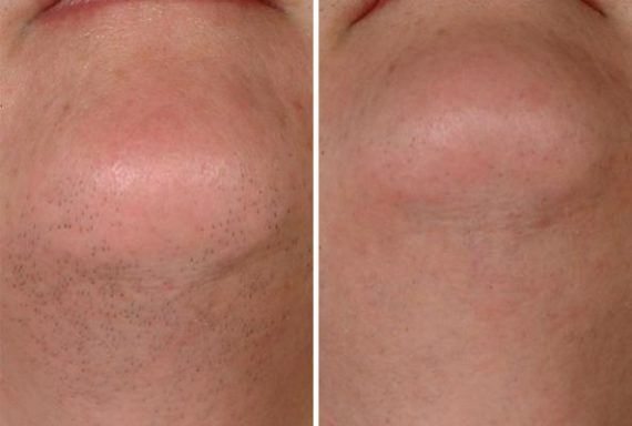Laser Hair Removal Before and After Photos in Houston, TX, Patient 8045