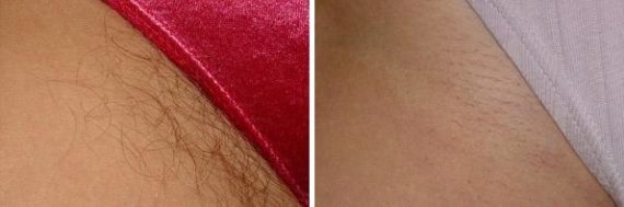 Laser Hair Removal Before and After Photos in Houston, TX, Patient 8048