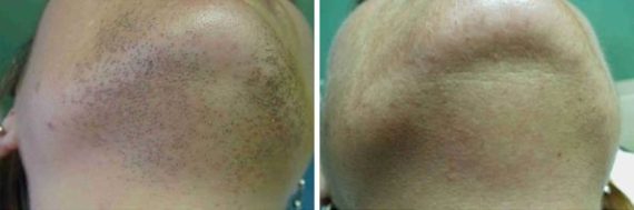 Laser Hair Removal Before and After Photos in Houston, TX, Patient 8051