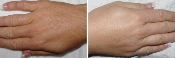 Laser Hair Removal Before and After Photos in Houston, TX, Patient 8036