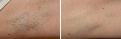 Laser Hair Removal Before and After Photos in Houston, TX, Patient 8054