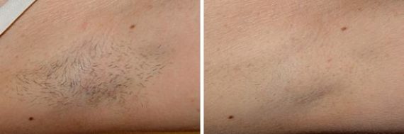 Laser Hair Removal Before and After Photos in Houston, TX