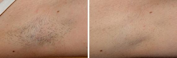 Laser Hair Removal Before and After Photos in Houston, TX, Patient 8054