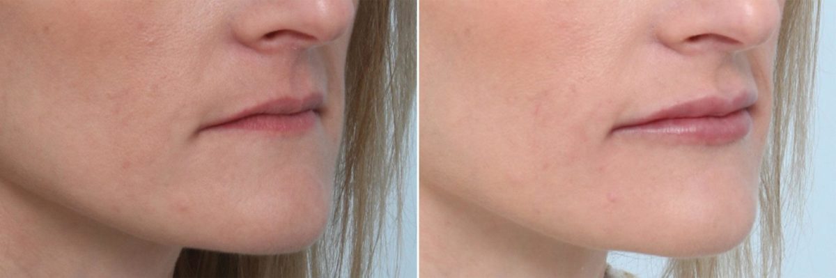 Lip Enhancement Before and After Photos in Houston, TX, Patient 8057