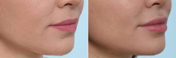 Lip Enhancement Before and After Photos in Houston, TX, Patient 8082