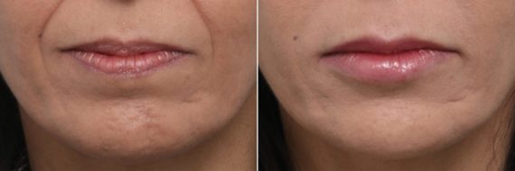 Lip Enhancement Before and After Photos in Houston, TX, Patient 8062