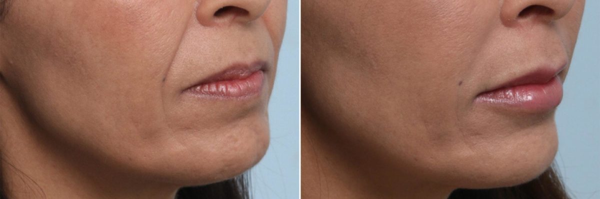 Lip Enhancement Before and After Photos in Houston, TX, Patient 8062