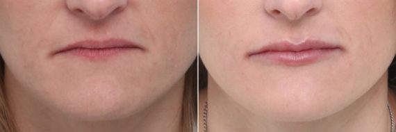 Lip Enhancement Before and After Photos in Houston, TX, Patient 8057