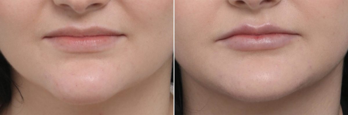Lip Enhancement Before and After Photos in Houston, TX, Patient 8072