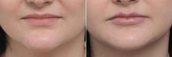 Lip Enhancement Before and After Photos in Houston, TX, Patient 8072