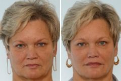 Radiesse Before and After Photos in Houston, TX, Patient 8099