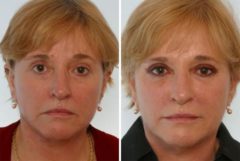 Radiesse Before and After Photos in Houston, TX, Patient 8114