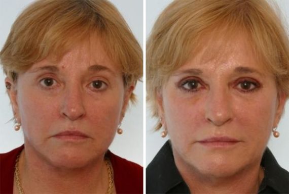 Radiesse Before and After Photos in Houston, TX, Patient 8114