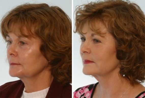 Radiesse Before and After Photos in Houston, TX, Patient 8122