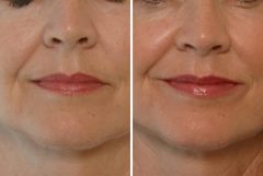 Restylane Before and After Photos in Houston, TX, Patient 8140