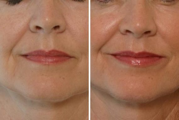 Restylane Before and After Photos in Houston, TX, Patient 8140