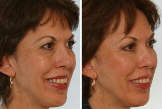 Restylane Before and After Photos in Houston, TX, Patient 8161