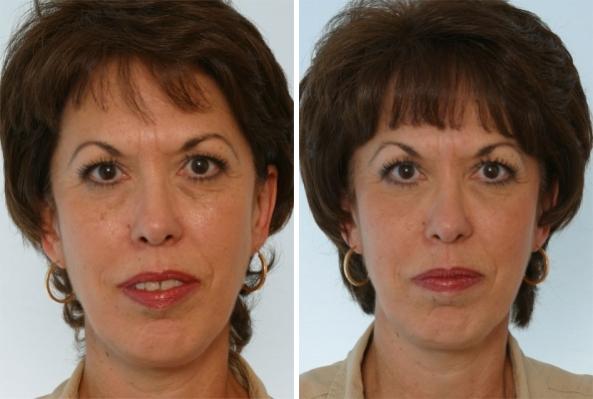 Restylane Before and After Photos in Houston, TX, Patient 8161