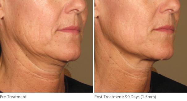 Side view of Patient's before and after images of Neck Rejuvenation by Dr. Paul Vitenas in Houston, TX.