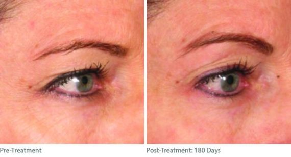 Ulthera Lift Before and After Photos in Houston, TX, Patient 8199
