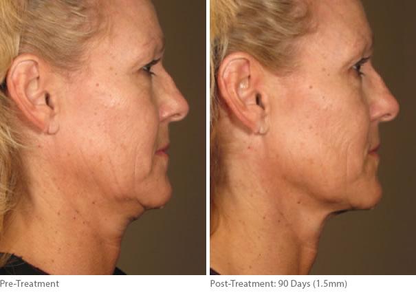 Ulthera Lift Before and After Photos in Houston, TX, Patient 8166