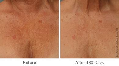 Ulthera Lift Before and After Photos in Houston, TX, Patient 8173