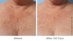 Ulthera Lift Before and After Photos in Houston, TX, Patient 8176