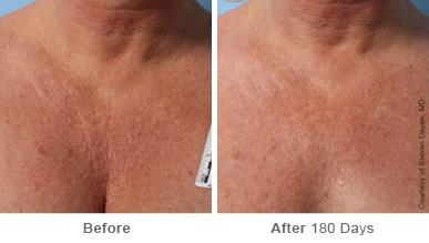 Ulthera Lift Before and After Photos in Houston, TX, Patient 8182