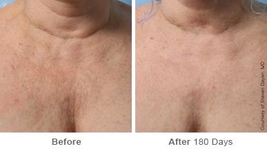 Ulthera Lift Before and After Photos in Houston, TX, Patient 8185