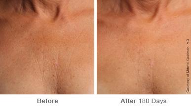 Ulthera Lift Before and After Photos in Houston, TX, Patient 8188