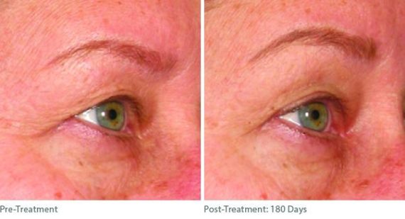 Ulthera Lift Before and After Photos in Houston, TX, Patient 8191